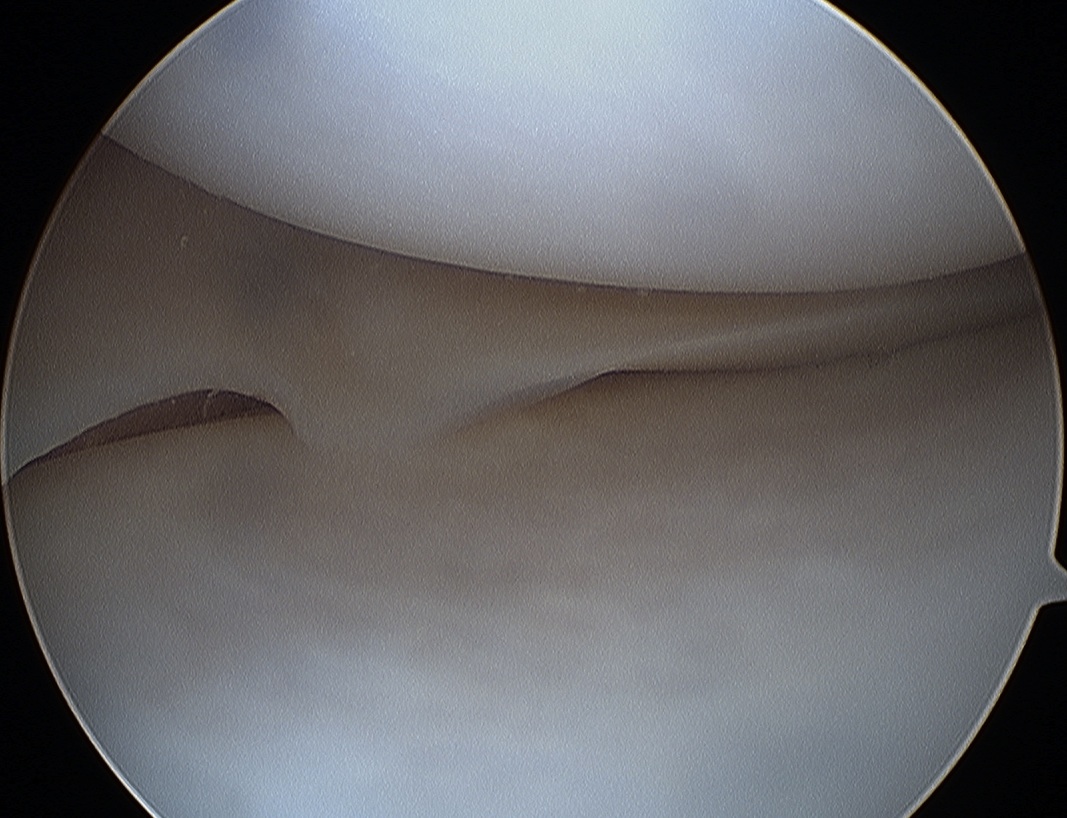 Medial Meniscus Normal